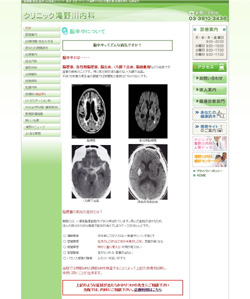 脳梗塞 症状